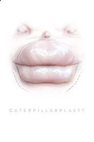 Caterpillarplasty